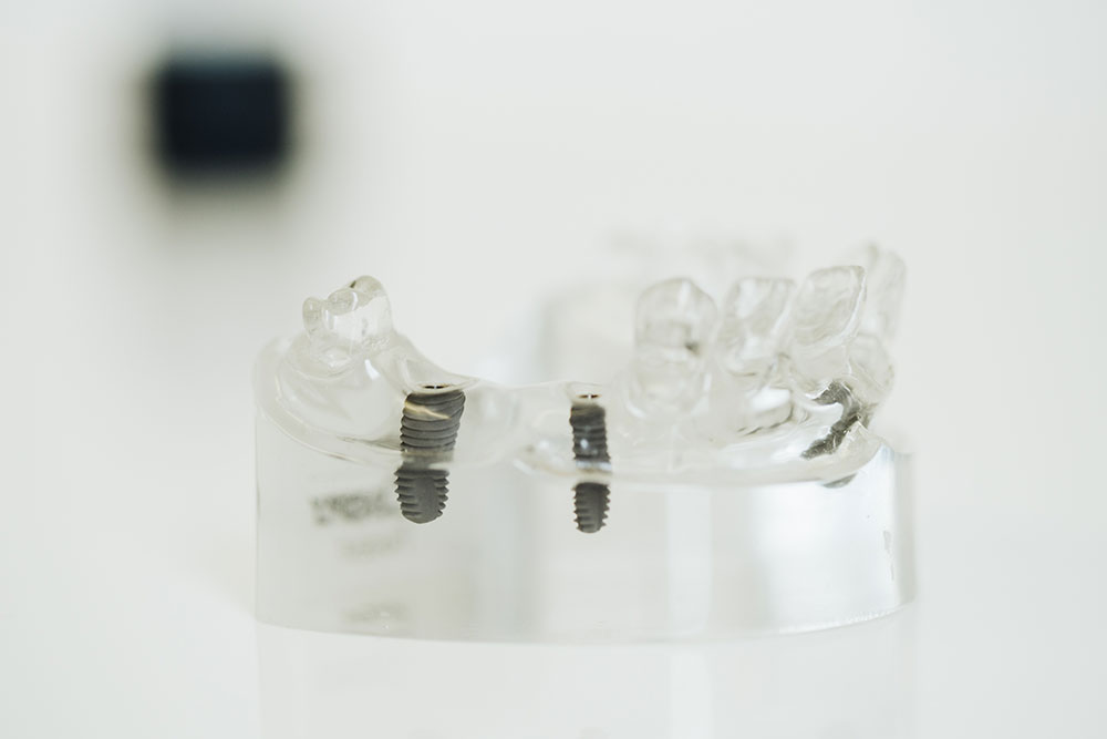 Zahnarzt Lörrach - Billek - Leistungen - Zahnersatz und Implantologie